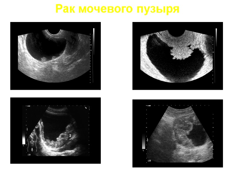 Рак мочевого пузыря